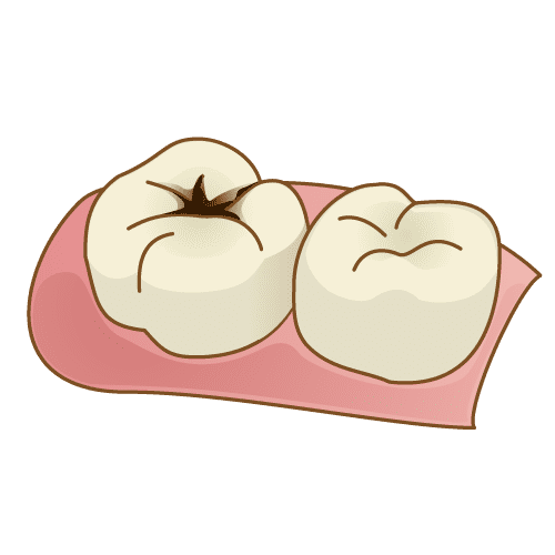 歯が黒い原因