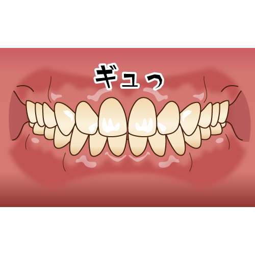 食いしばりの特徴とセルフチェック