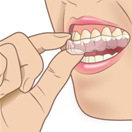マウスピースの矯正は効果あるの？