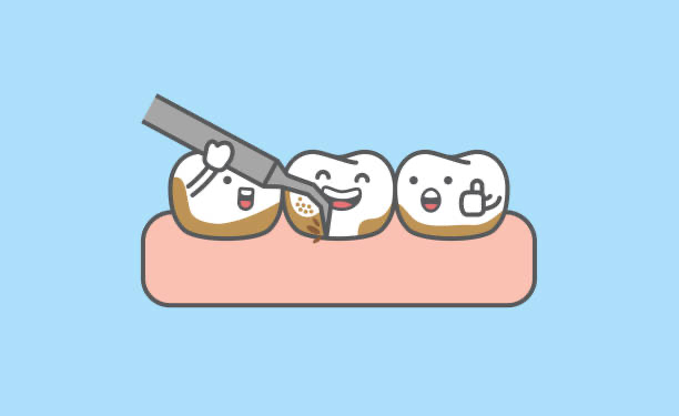 歯石と歯垢は何が違うの？