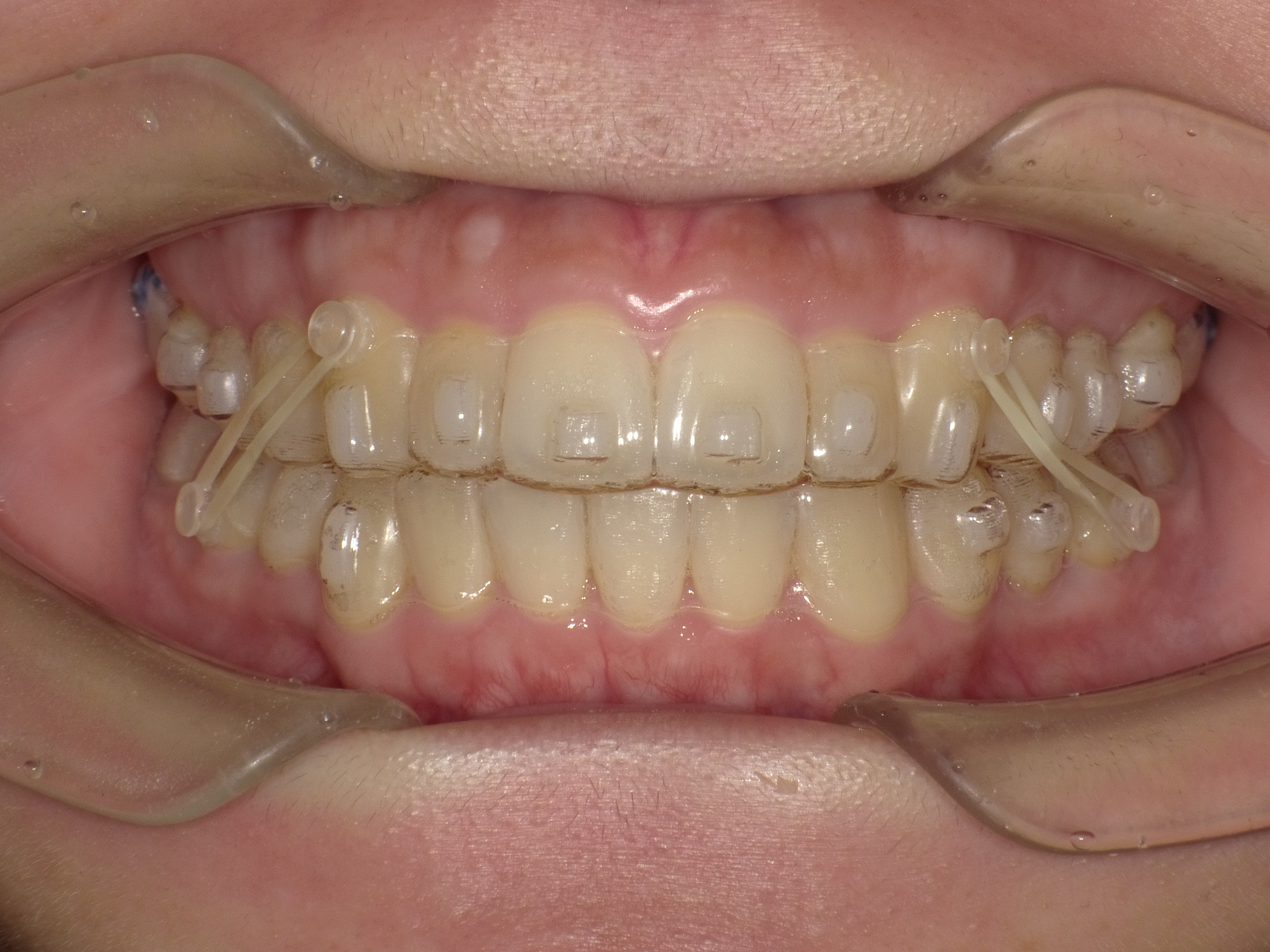 🦷インビザライン開始から1年…今年から顎間ゴムを使うことになりました！