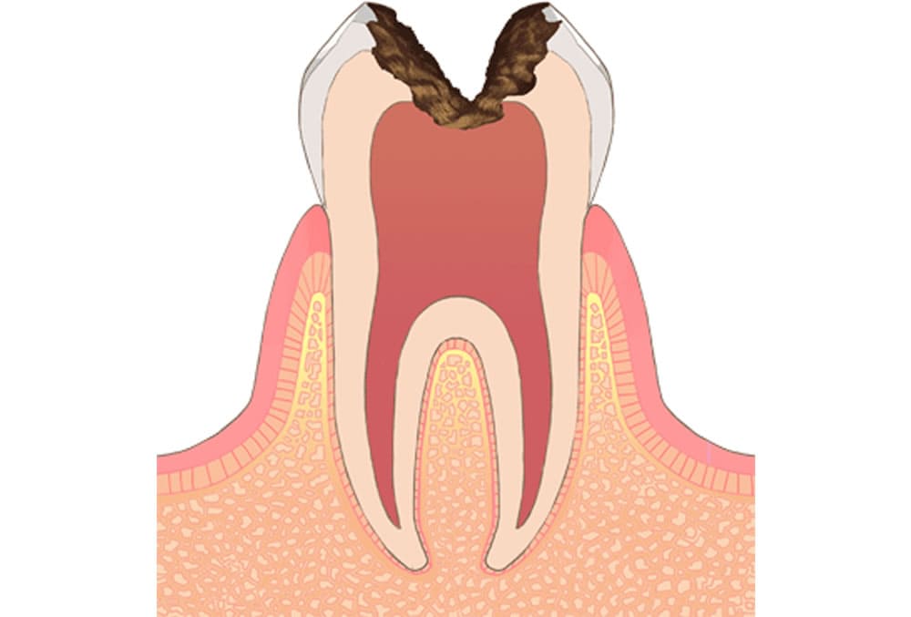 神経に到達した虫歯