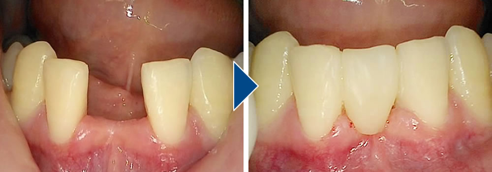 虫歯治療後にCR（コンポジットレジン）で修復した症例