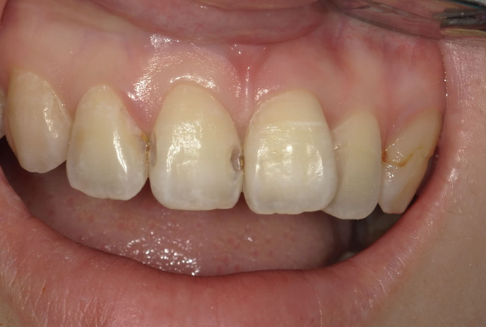 虫歯の除去