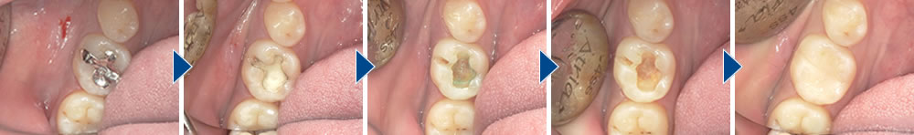 虫歯治療後にCR（コンポジットレジン）で修復した症例
